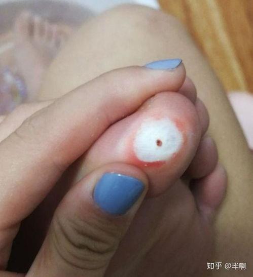吃瓜长鸡眼,揭秘日常饮食与鸡眼形成的惊人关系